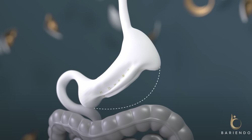 Endoscopic sleeve gastroplasty (ESG) diagram